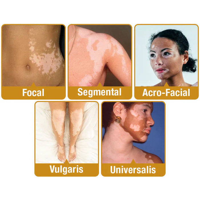 ELITEPRO™ BEE VENOM VITILIGO TREATMENT CREAM