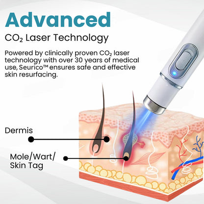 ✨Seurico™ Laser Pen - Non-invasive Mole and Wart Removal