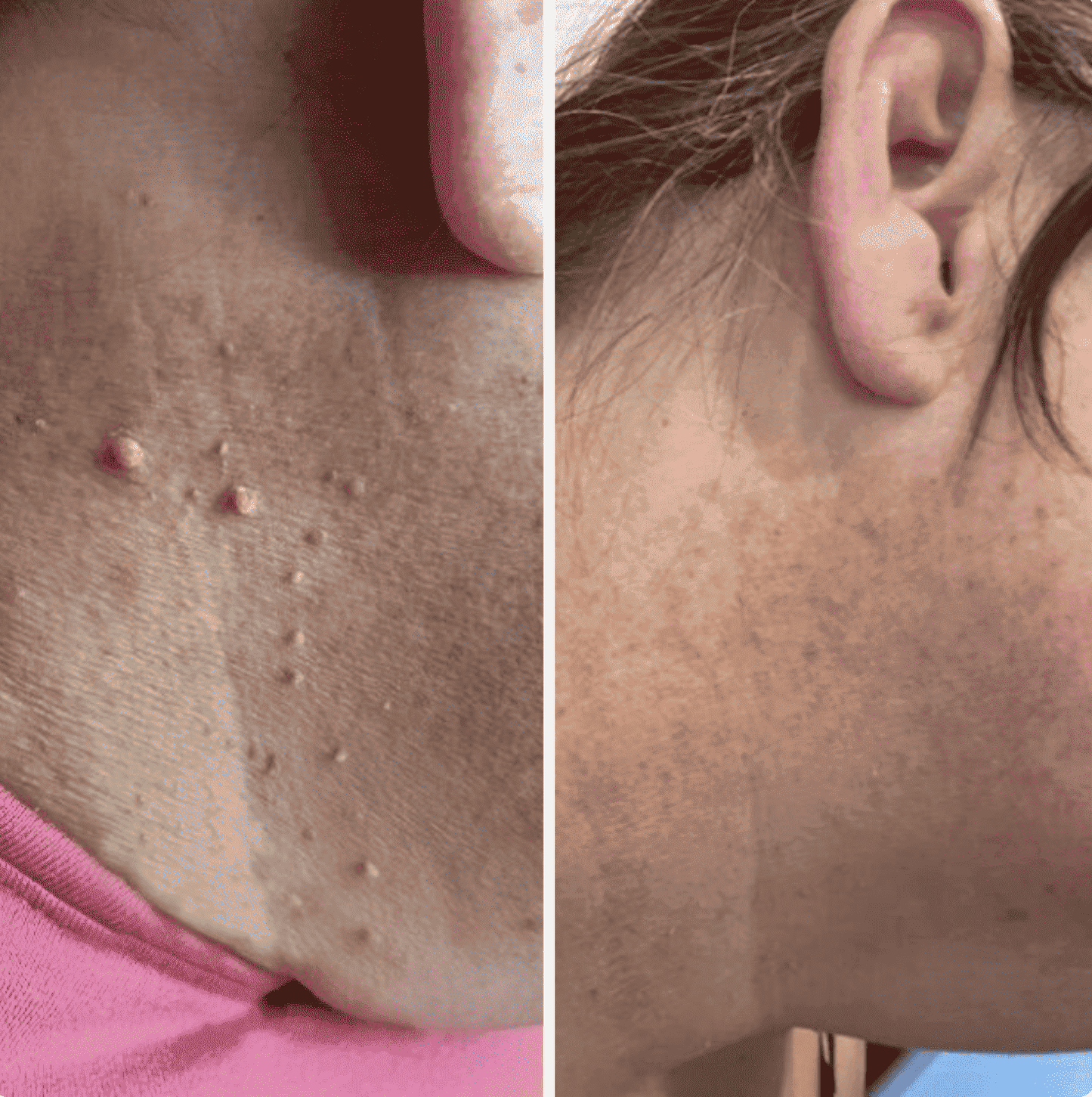 Premium Painless Skin Tag Removal (100% Working)