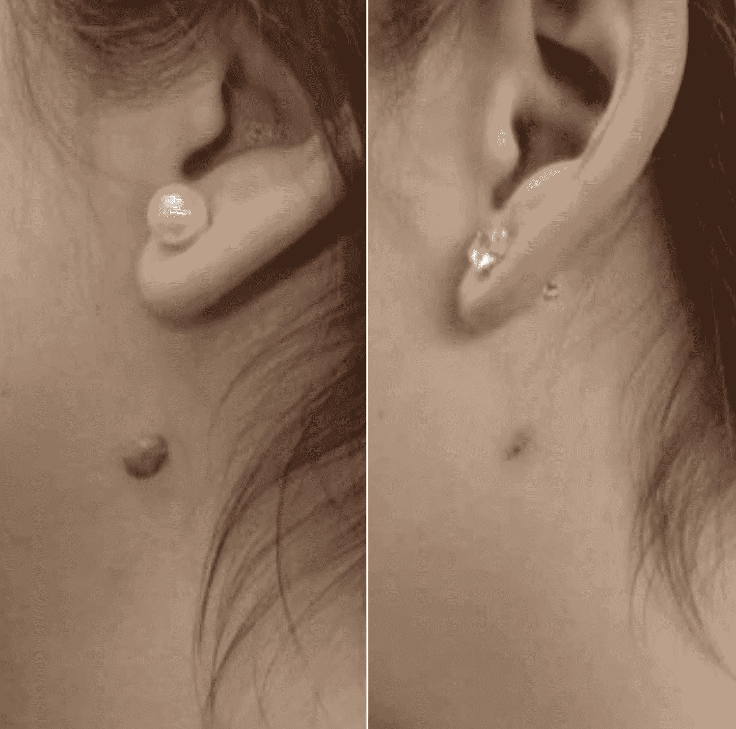 Premium Painless Skin Tag Removal (100% Working)