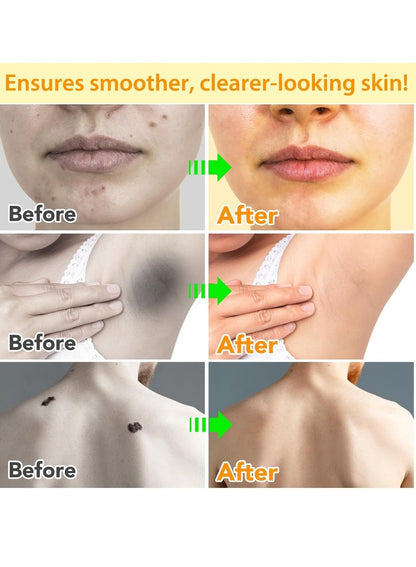 Tags & Moles Remover