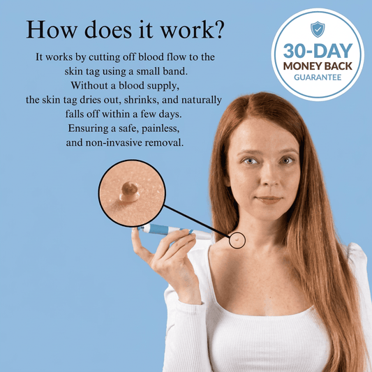 Premium Painless Skin Tag Removal (100% Working)